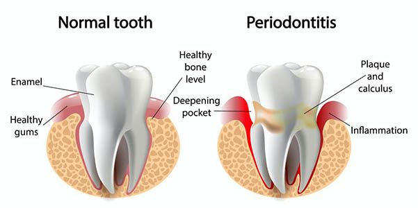 Nhà chu là gì? Tiến trình phát triển của bệnh viêm nha chu