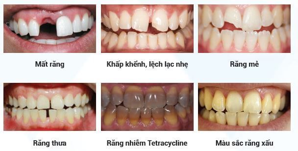 rang-su-tham-my-nha-khoa-kim-2.jpg