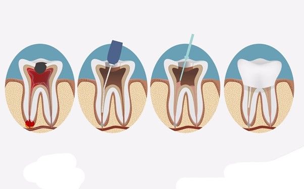 Thế nào là nội nha? Khi nào cần điều trị nội nha?