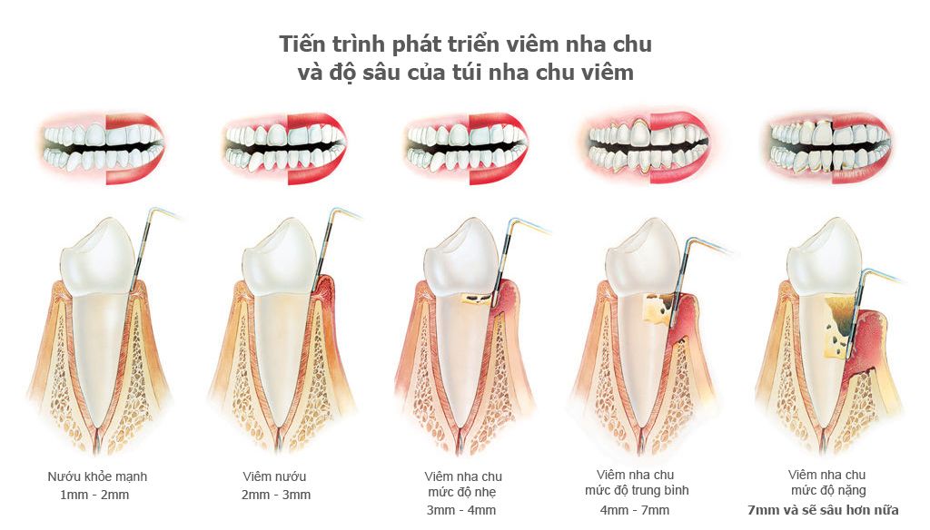 tien-trien-cua-benh-viem-nha-chu.jpg