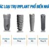 Răng Implant làm từ chất liệu gì?