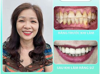 Cảm Nhận Từ TRÁI TIM Của Dì CẨM LIÊN Sau Khi Làm Răng Tại NHA KHOA PHƯƠNG DENTIST