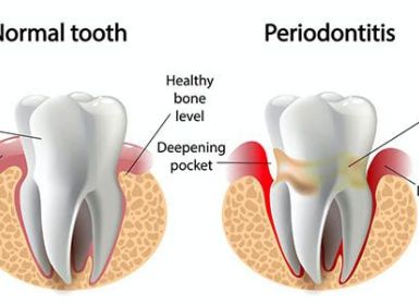 Nhà chu là gì? Tiến trình phát triển của bệnh viêm nha chu