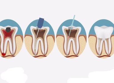 Thế nào là nội nha? Khi nào cần điều trị nội nha?