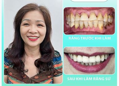 Cảm Nhận Từ TRÁI TIM Của Dì CẨM LIÊN Sau Khi Làm Răng Tại NHA KHOA PHƯƠNG DENTIST