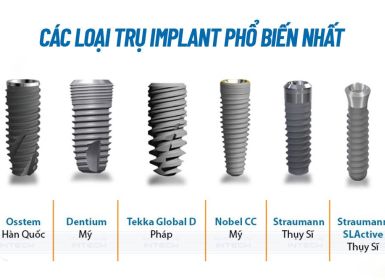 Răng Implant làm từ chất liệu gì?