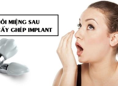 Trồng răng implant có bị hôi miệng không? Tại sao bị hôi miệng khi cấy Implant?