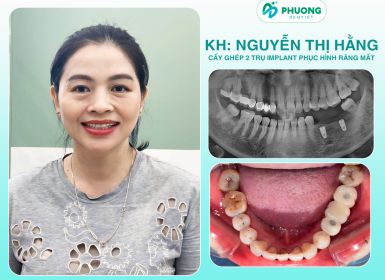 Hình ảnh trước / sau cắm Implant