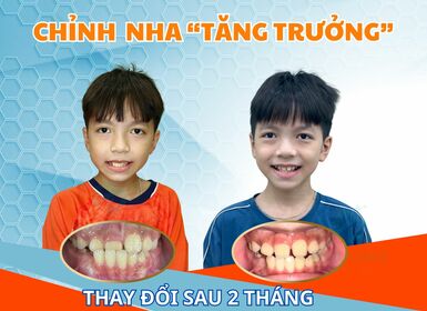 Chỉnh nha "TĂNG TRƯỞNG"