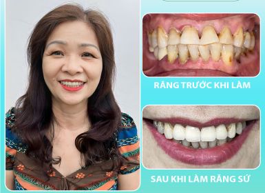 Hình ảnh trước / sau Thẩm mỹ