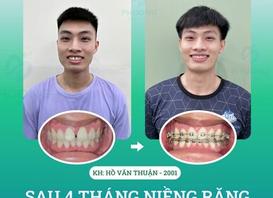 NIỀNG RĂNG - KHÉP CỬA KHE THƯA