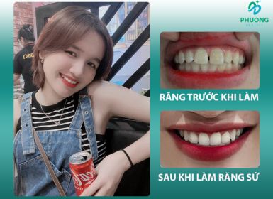 Hình ảnh trước / sau