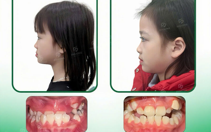 CHỈNH NHA TĂNG TRƯỞNG