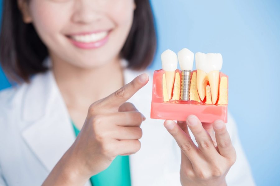 Thời gian chờ làm phục hình trên Implant mất bao lâu?