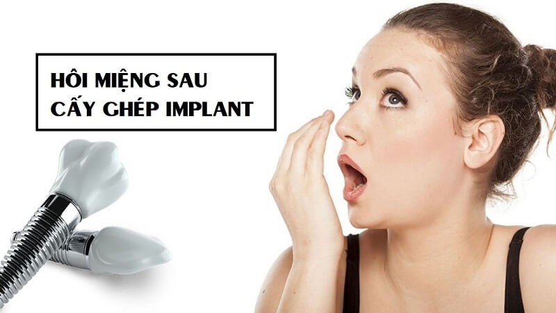 Trồng răng implant có bị hôi miệng không? Tại sao bị hôi miệng khi cấy Implant?