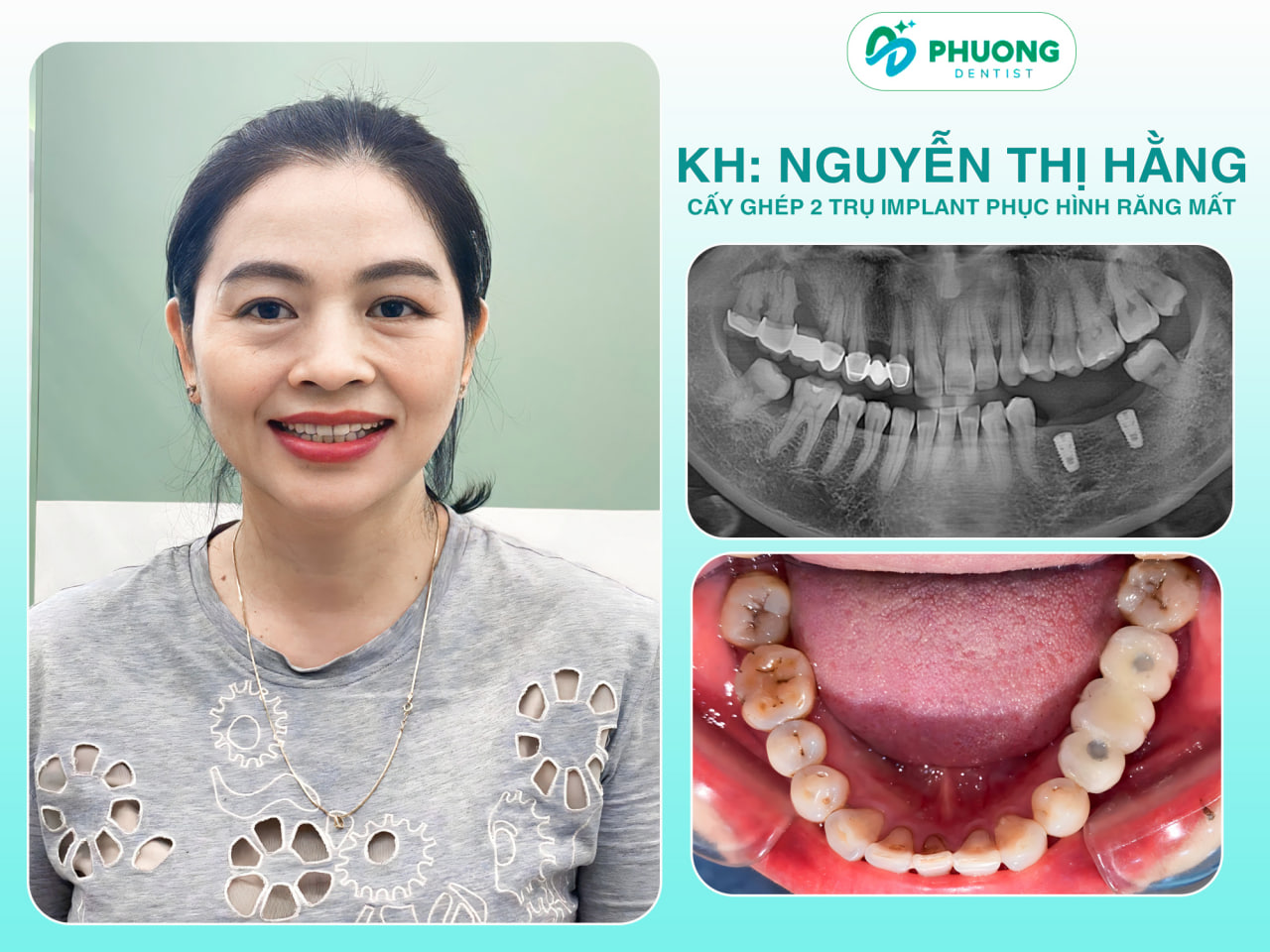 Hình ảnh trước / sau cắm Implant