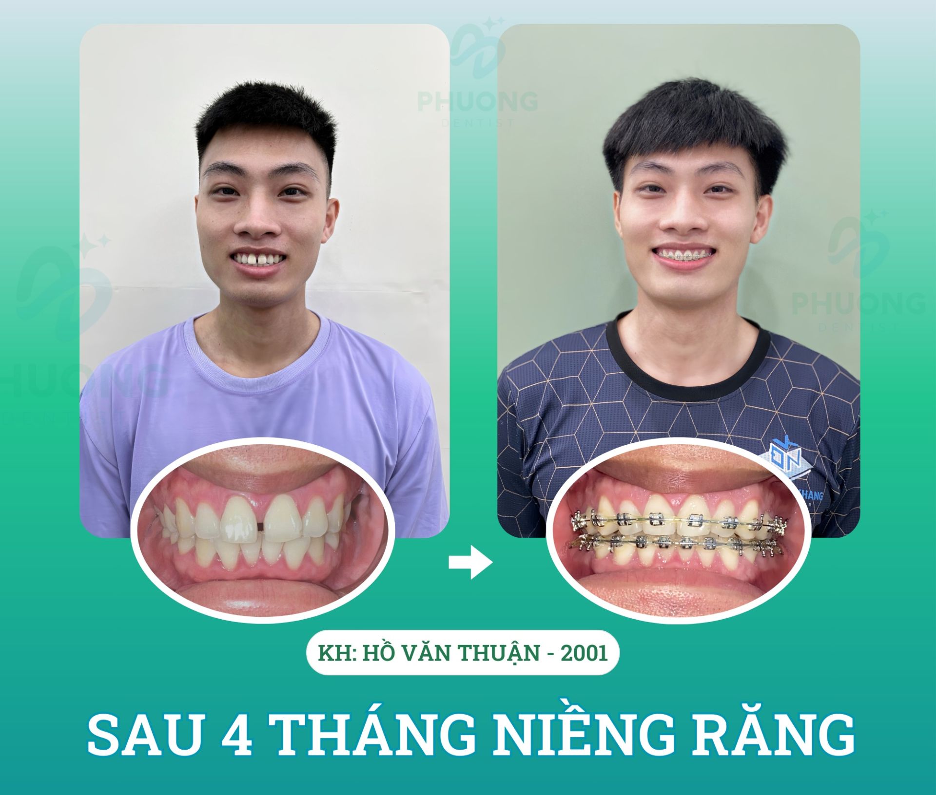 NIỀNG RĂNG - KHÉP CỬA KHE THƯA