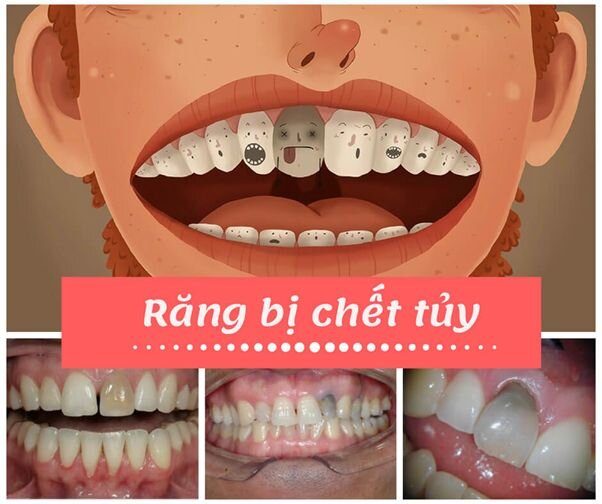 khi-rang-bi-chet-tuy_cc4fe068_c19e_4f1f_bc88_964897f67a94.png
