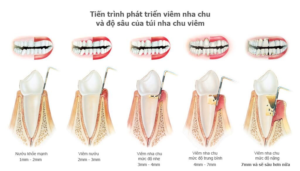 tien-trien-cua-benh-viem-nha-chu.jpg